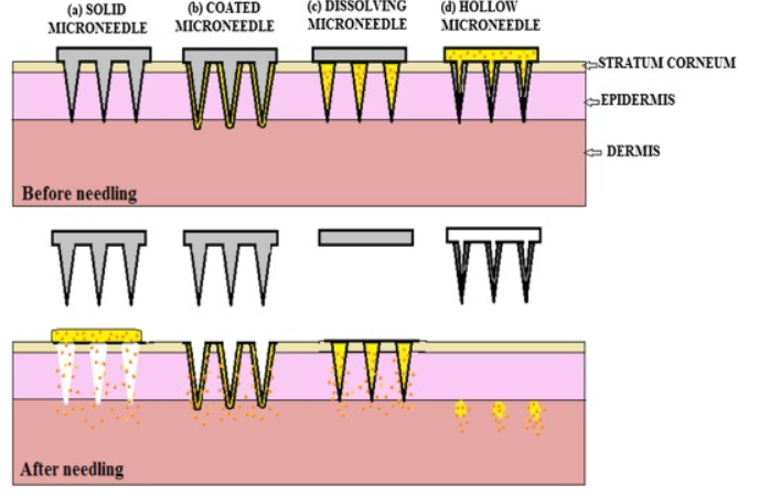 마이크로 니들의 종류