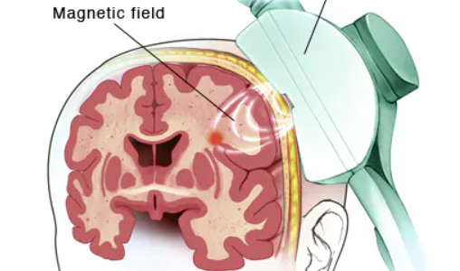 TMS 경두개자기자극 | 원리, 이점, 부작용
