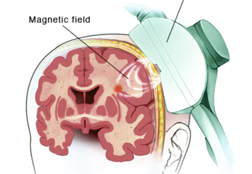 TMS 경두개자기자극 | 원리, 이점, 부작용